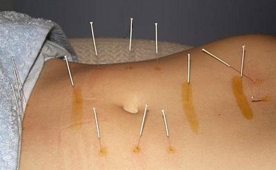 acupuntura tratamiento del dolor Marbella